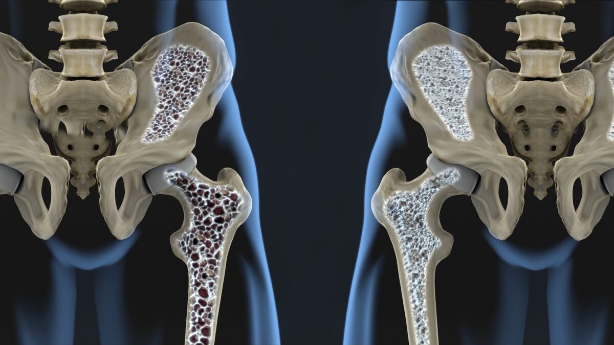 Simple Tips To Reverse Osteoporosis