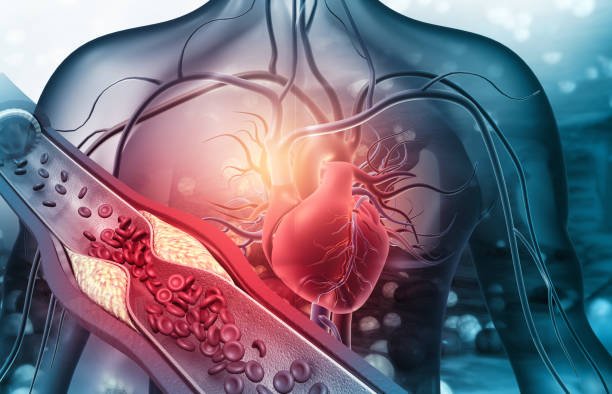 Foods To Reverse Atherosclerosis