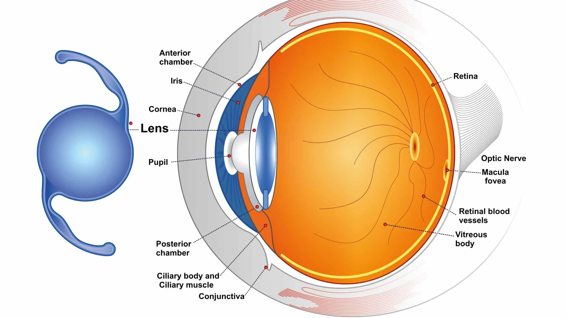 intervento-cataratta-iol-lenti-intraoculari-schema-passani