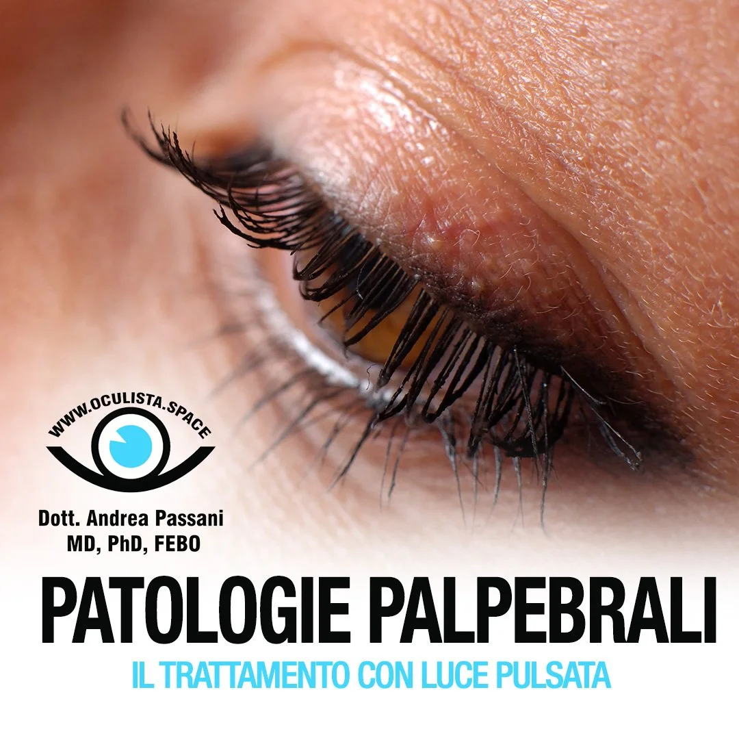 Patologie palpebrali: il trattamento con luce pulsata
