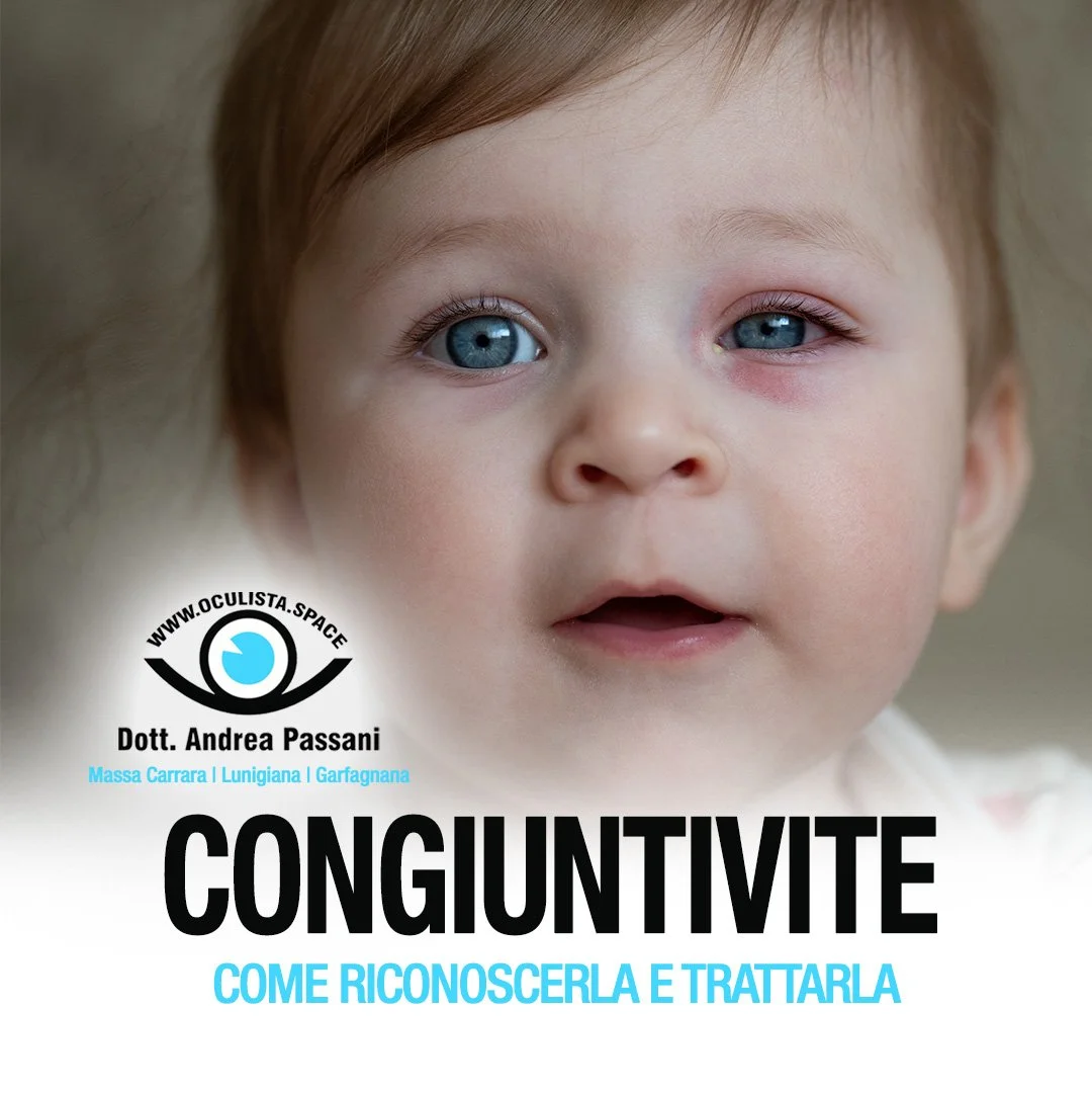 La Congiuntivite: come riconoscerla e trattarla