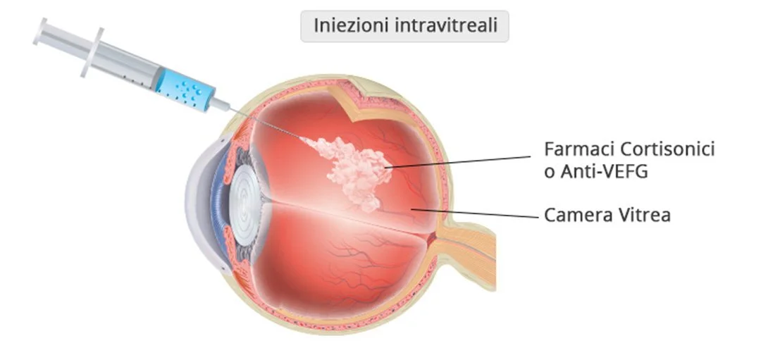 iniezioni-intravitreali-retinopatie-maculopatie-vegf-oculista-andrea-passani-come-funzionano