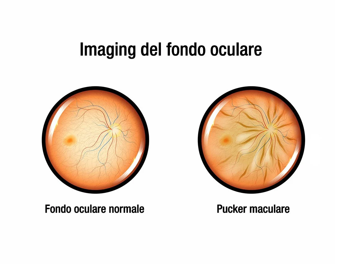pucker-maculare-membrana-epiretinica-passani-esame-fondo-oculare
