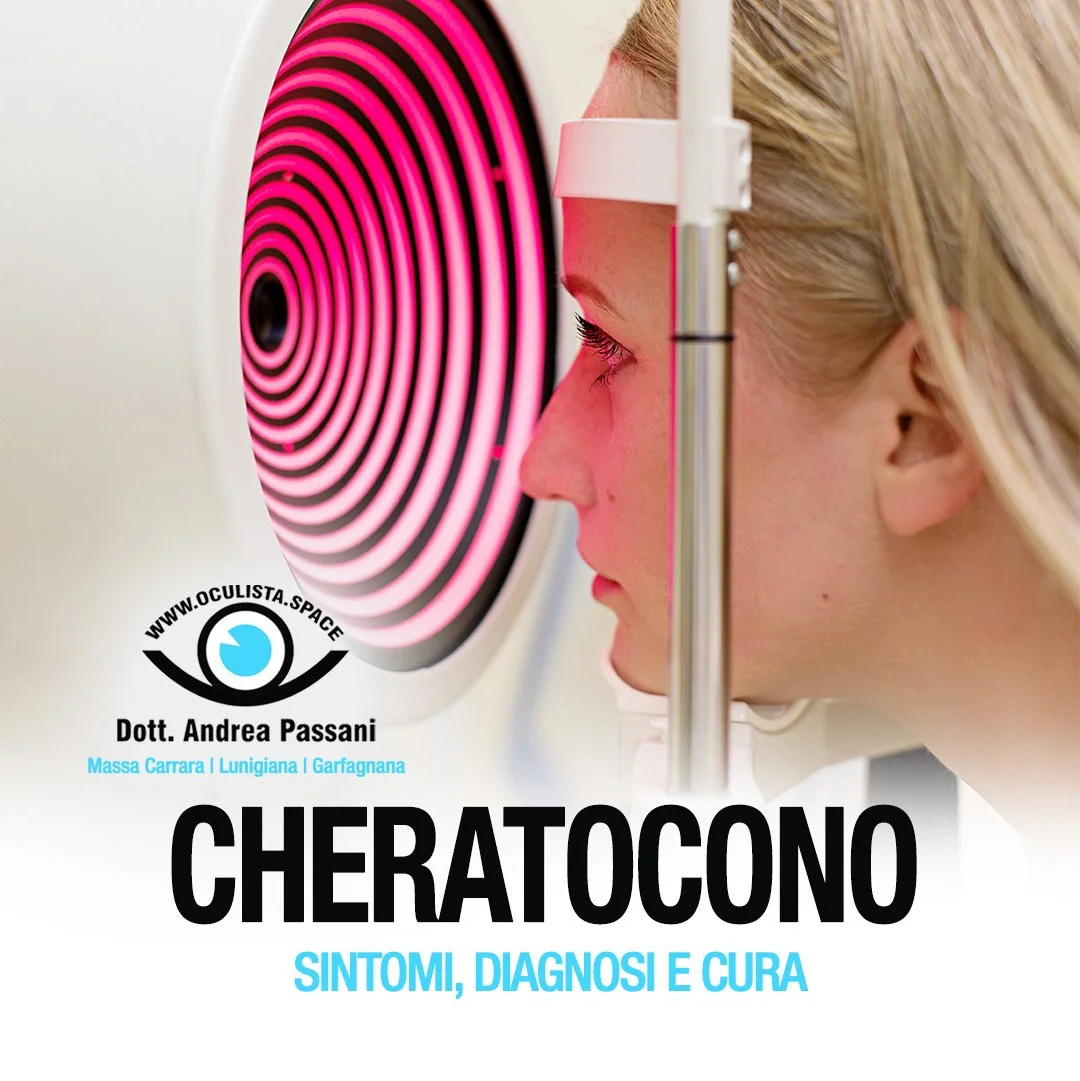 Cheratocono: sintomi, diagnosi e cura