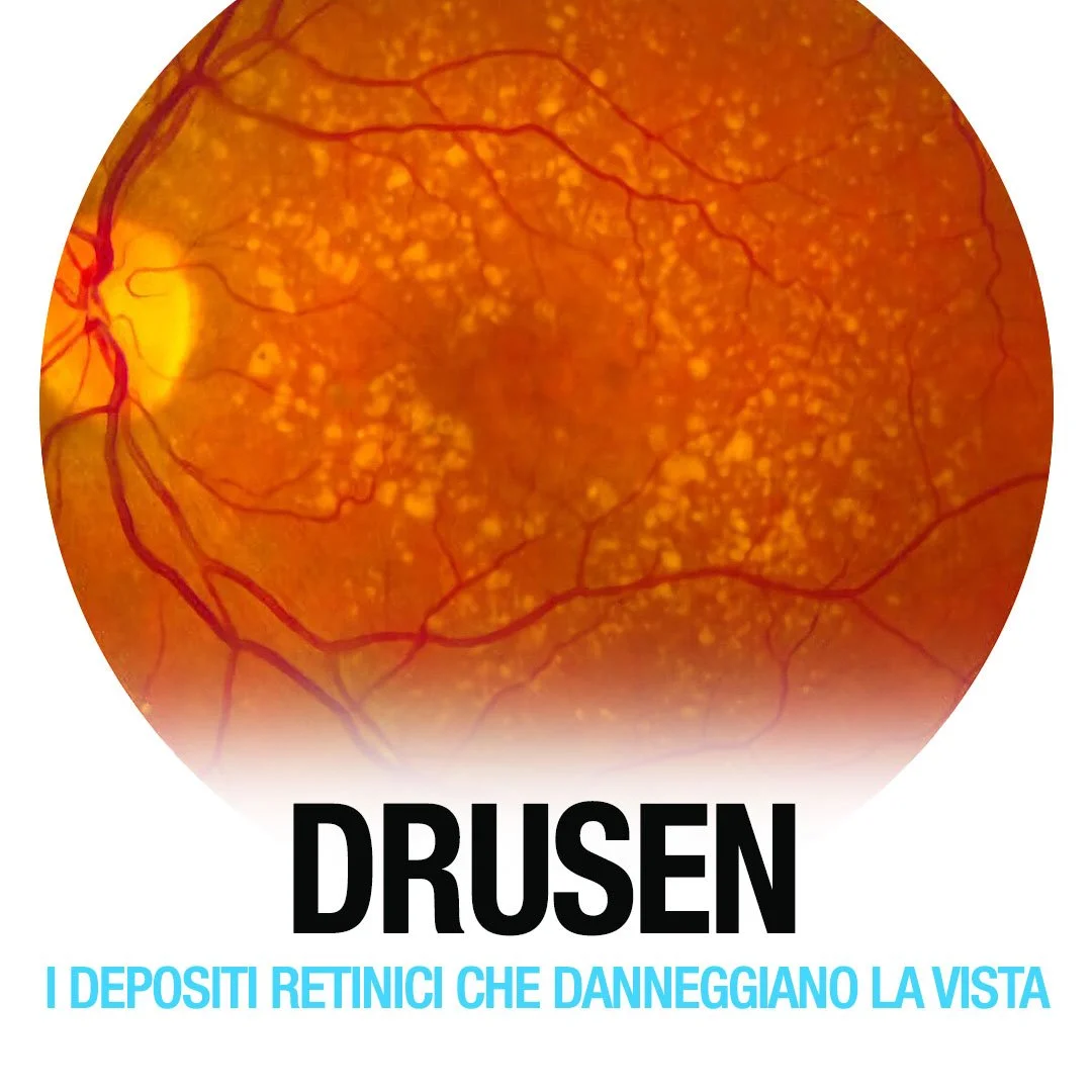 Drusen e degenerazione maculare