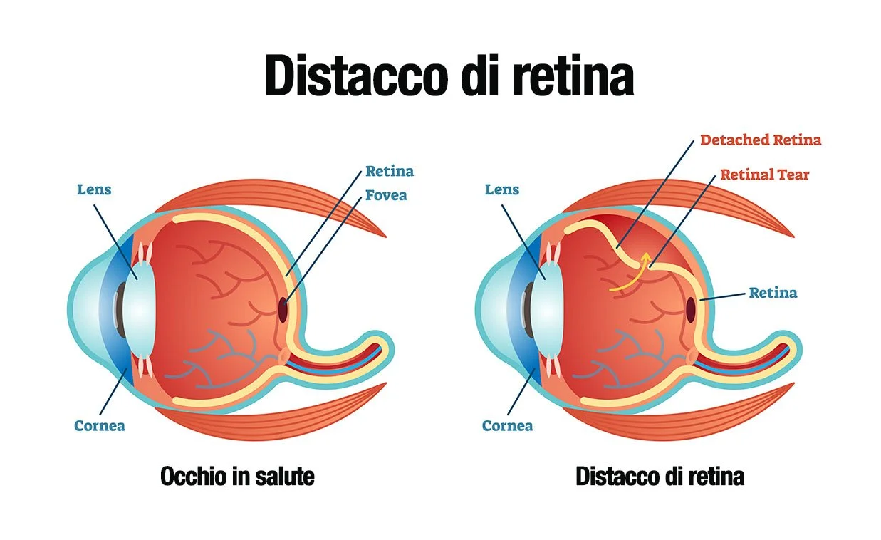 sintomi-distacco-di-retina-anatomia.jpg