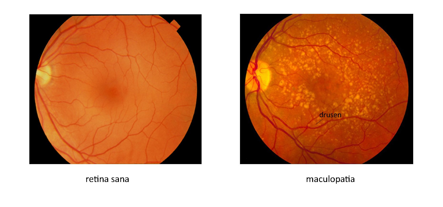 retinopatia-maculopatia-amsler-test.jpg