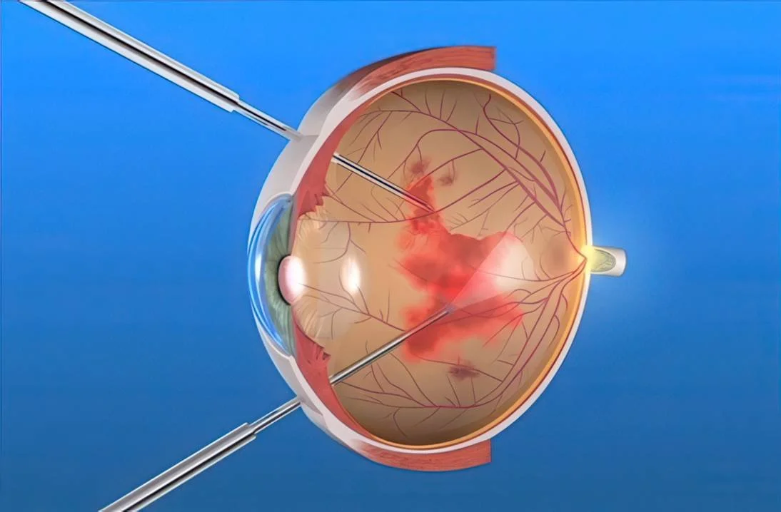 emovitreo-trattamento-vitrectomia-andrea-passani-oculista.