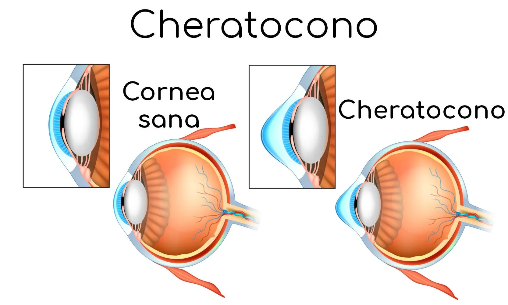 cheratocono-anatomia
