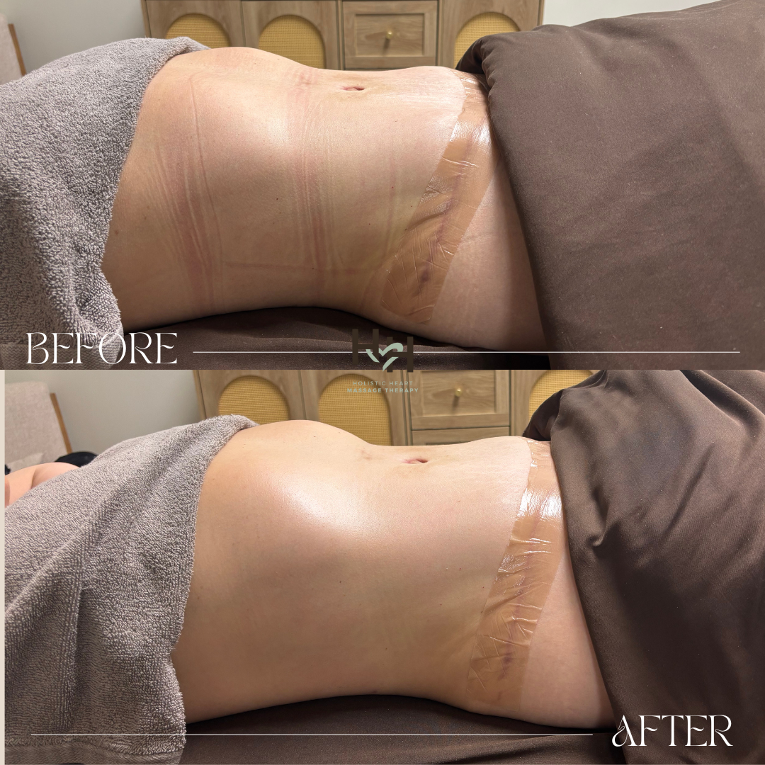 before and after post-surgery lymphatic massage for tummy tuck