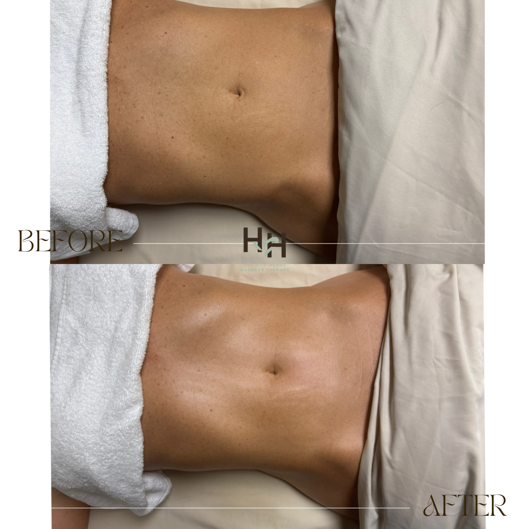 before and after stomach contour with lymphatic drainage