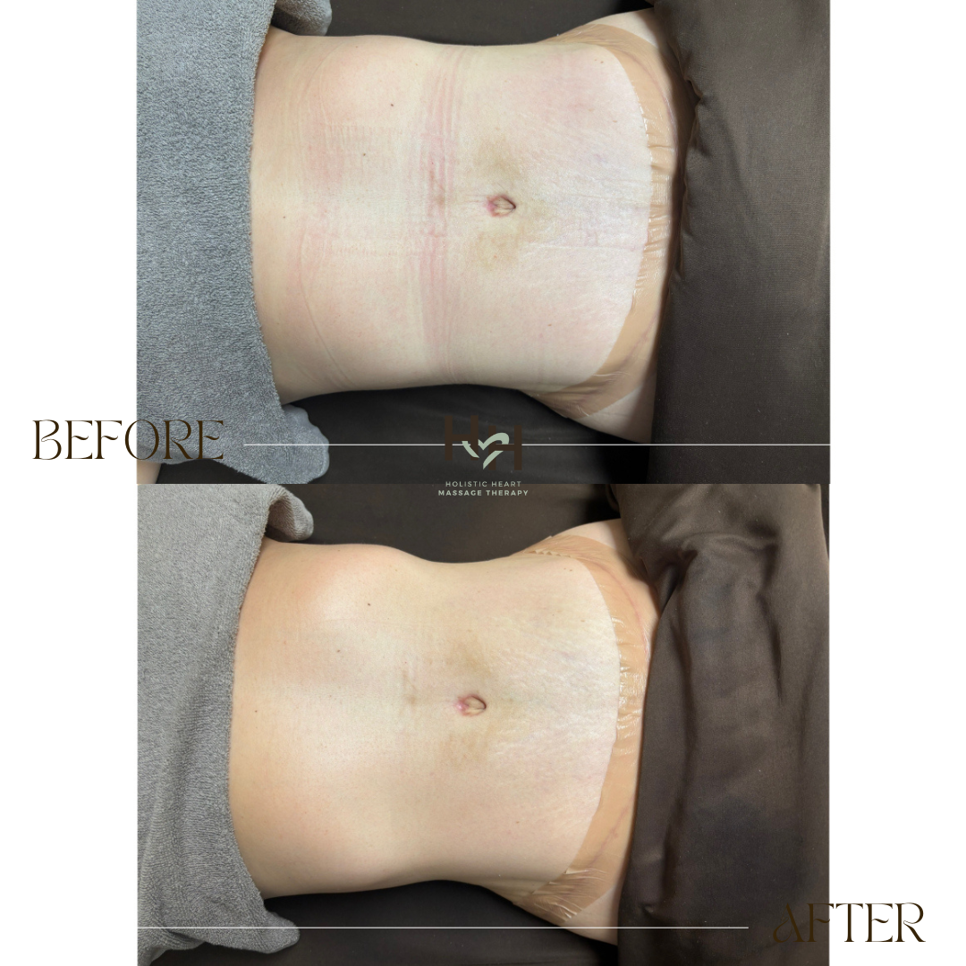 post surgery lymphatic massage results