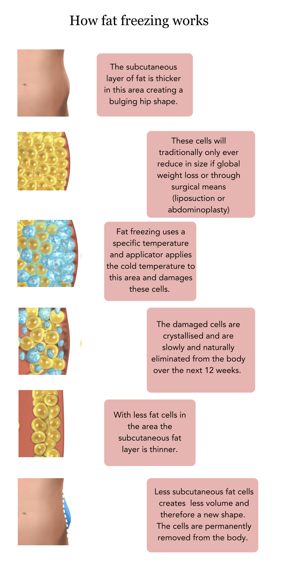 How+fat+freezing+works+graphic+horizontal+.png?format=1000w