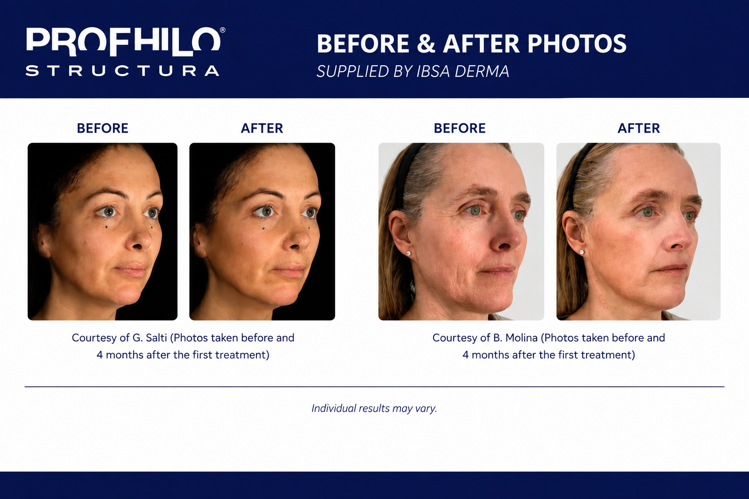 Profhilo Structura before and after treatment showing natural improvement in facial volume, contour and skin support at Face to Face by Marjan in Sydney.