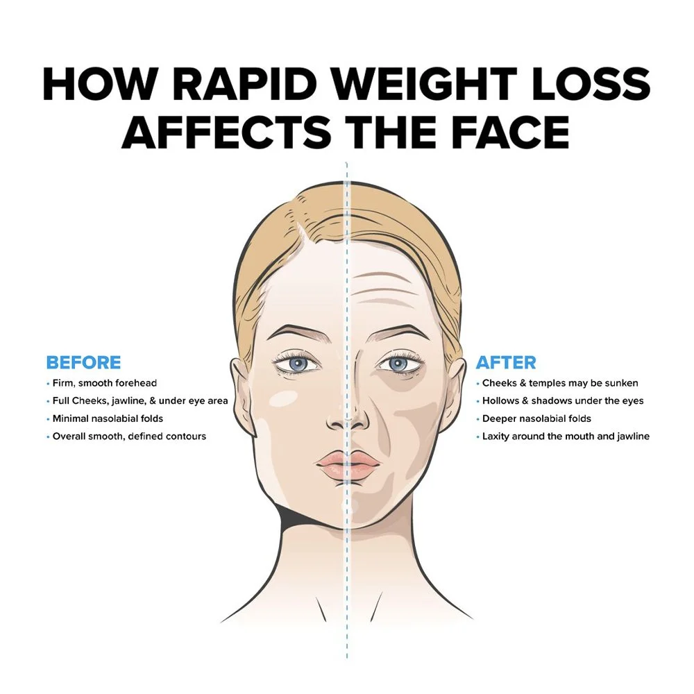 Ozempic Face: Why Rapid Weight Loss Can Age the Face — and How We Can Support Facial Volume Naturally