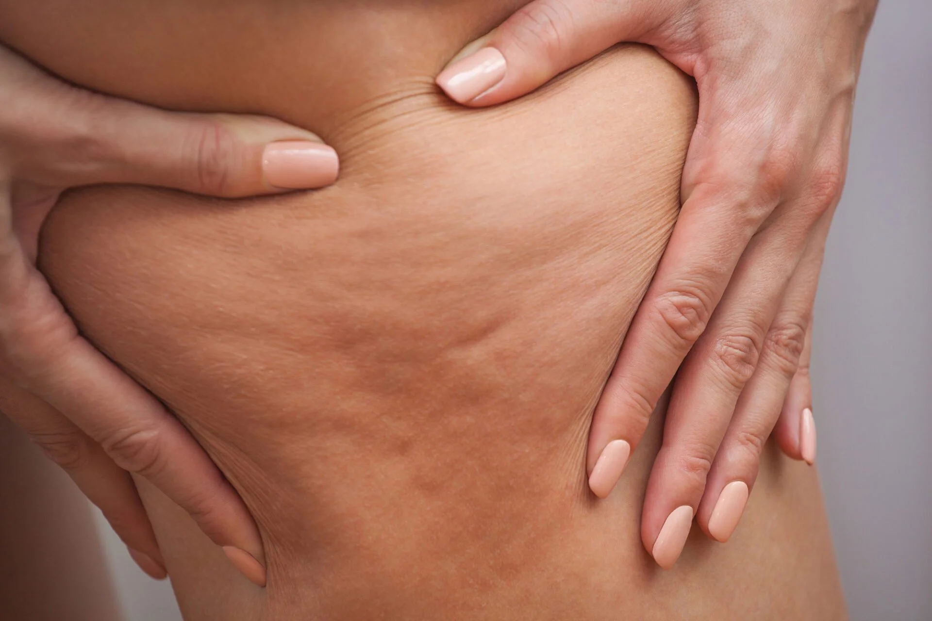 Cellulite Treatment: Sculptra, Subcision and Collagen Stimulation