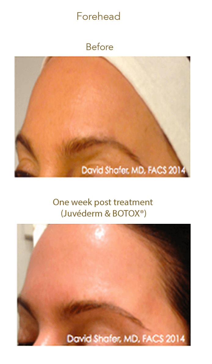AquaGold before and after results showing forehead skin appearance