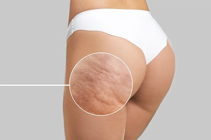 Close-up view of cellulite dimpling and skin texture on the buttocks