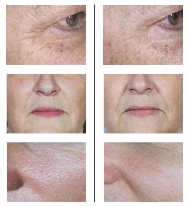 Before and after NCTF skin booster treatment showing changes in skin quality, texture and hydration