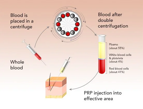 Diagram showing PRP preparation from whole blood using centrifugation before injection into the treatment area