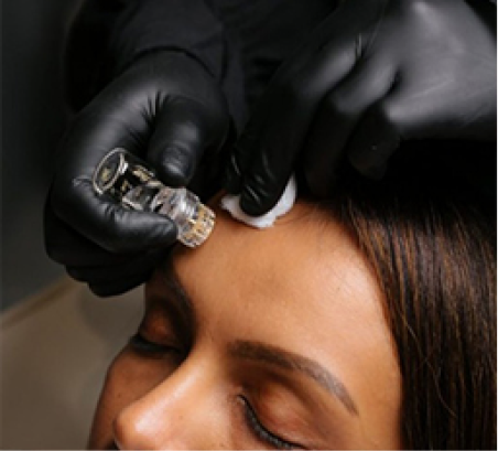 Aquagold facial skin rejuvenation treatment at Face-to-Face by Marjan in Leichhardt Sydney