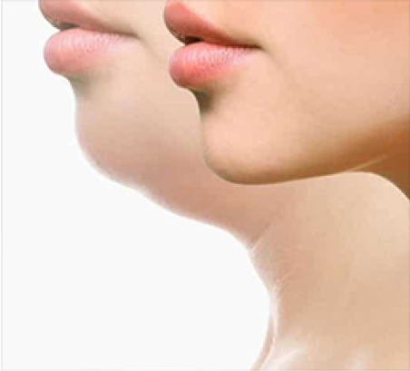 Fat dissolving treatment for facial contouring at Face-to-Face by Marjan in Sydney