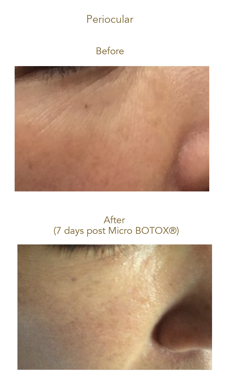 AquaGold before and after results showing skin around the eye area