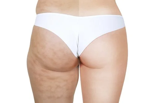 Visible cellulite dimpling and uneven skin texture on the buttocks and upper thighs