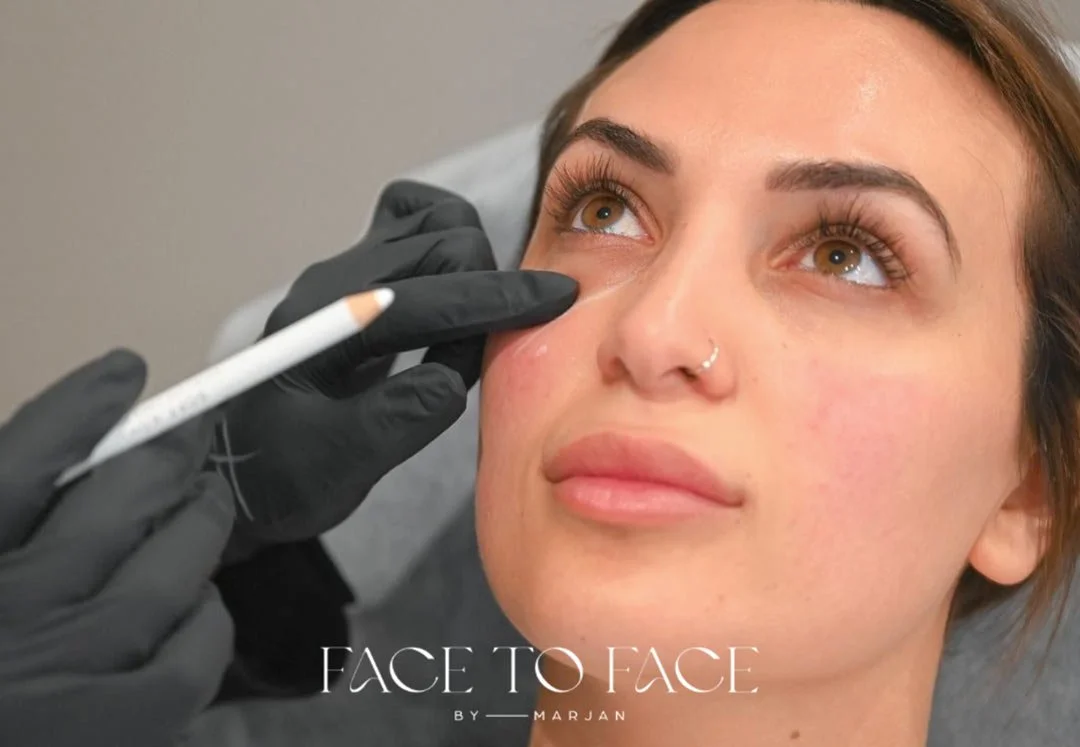 Cosmetic practitioner performing a Rejuran polynucleotide skin rejuvenation treatment to improve collagen production and skin quality at Face to Face by Marjan in Leichhardt, Sydney.
