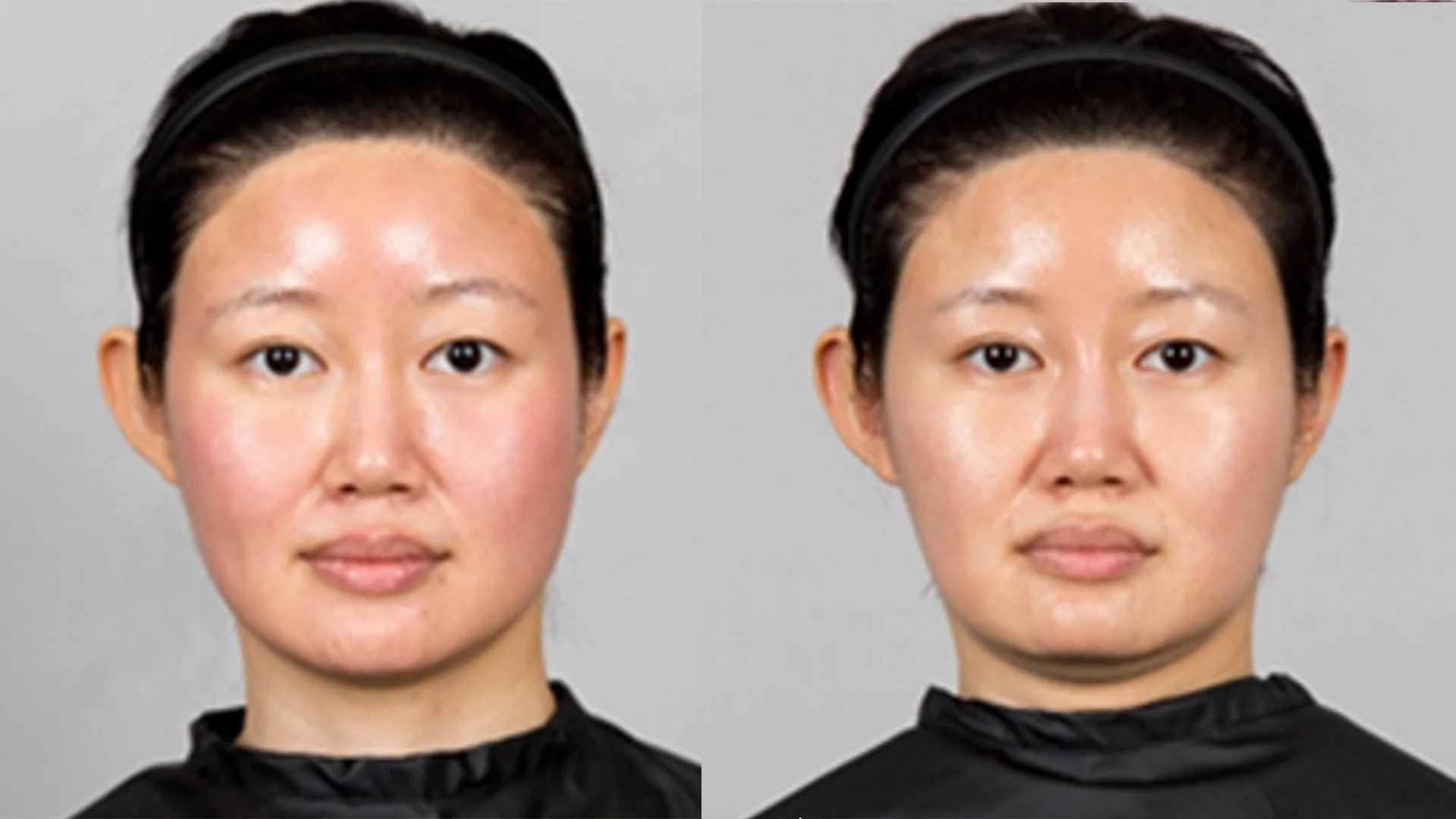Before and after Rejuran polynucleotide treatment showing improved skin quality, hydration and overall facial rejuvenation at Face to Face by Marjan in Leichhardt, Sydney.