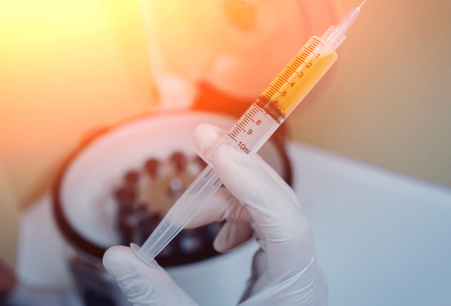 Prepared platelet-rich plasma syringe for PRP hair restoration treatment in Sydney