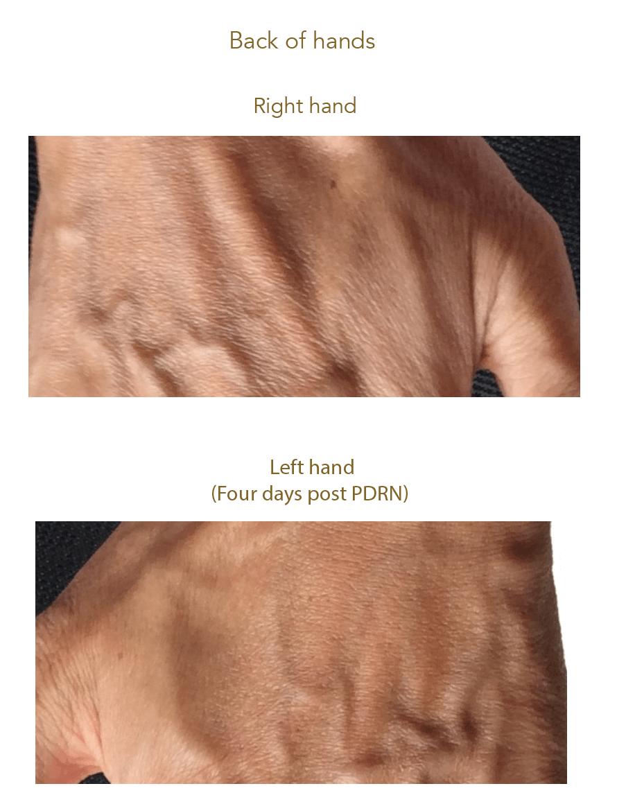 AquaGold before and after results showing skin rejuvenation of the hands