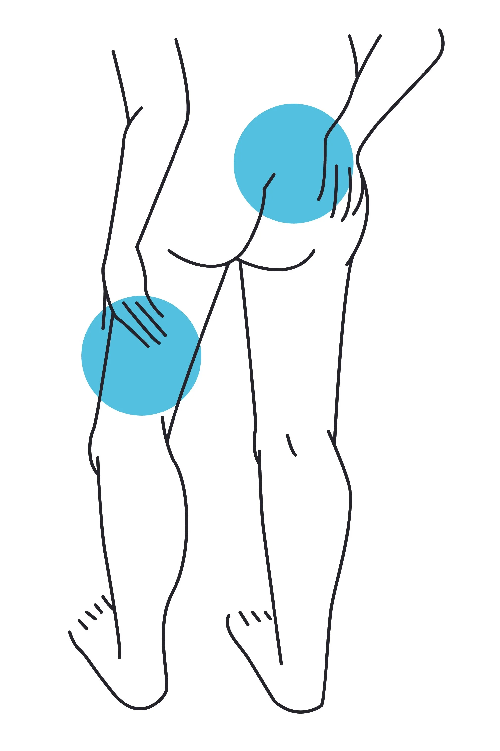 Hand-drawn illustration showing common sciatica pain patterns radiating from the lower back into the leg.