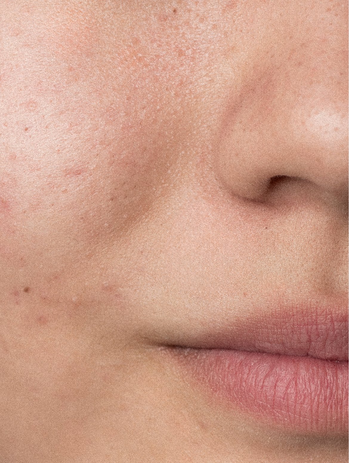 Selfnamed Acne Care1.jpg