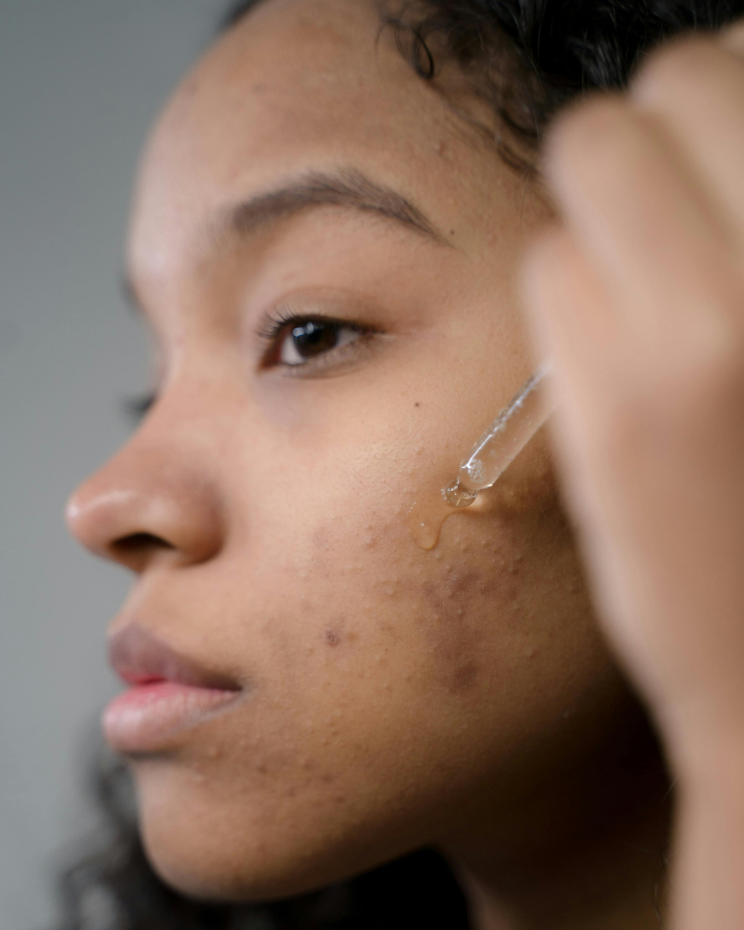 How to Market Acne Solutions in a Gen Z–Driven Skincare Market