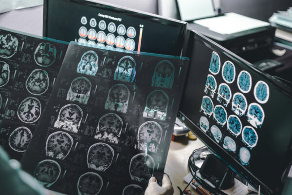 9 Signs of Early Alzheimer’s Disease