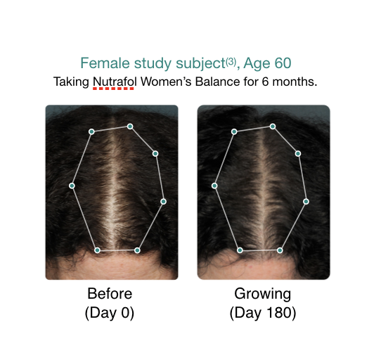 Hair thinning