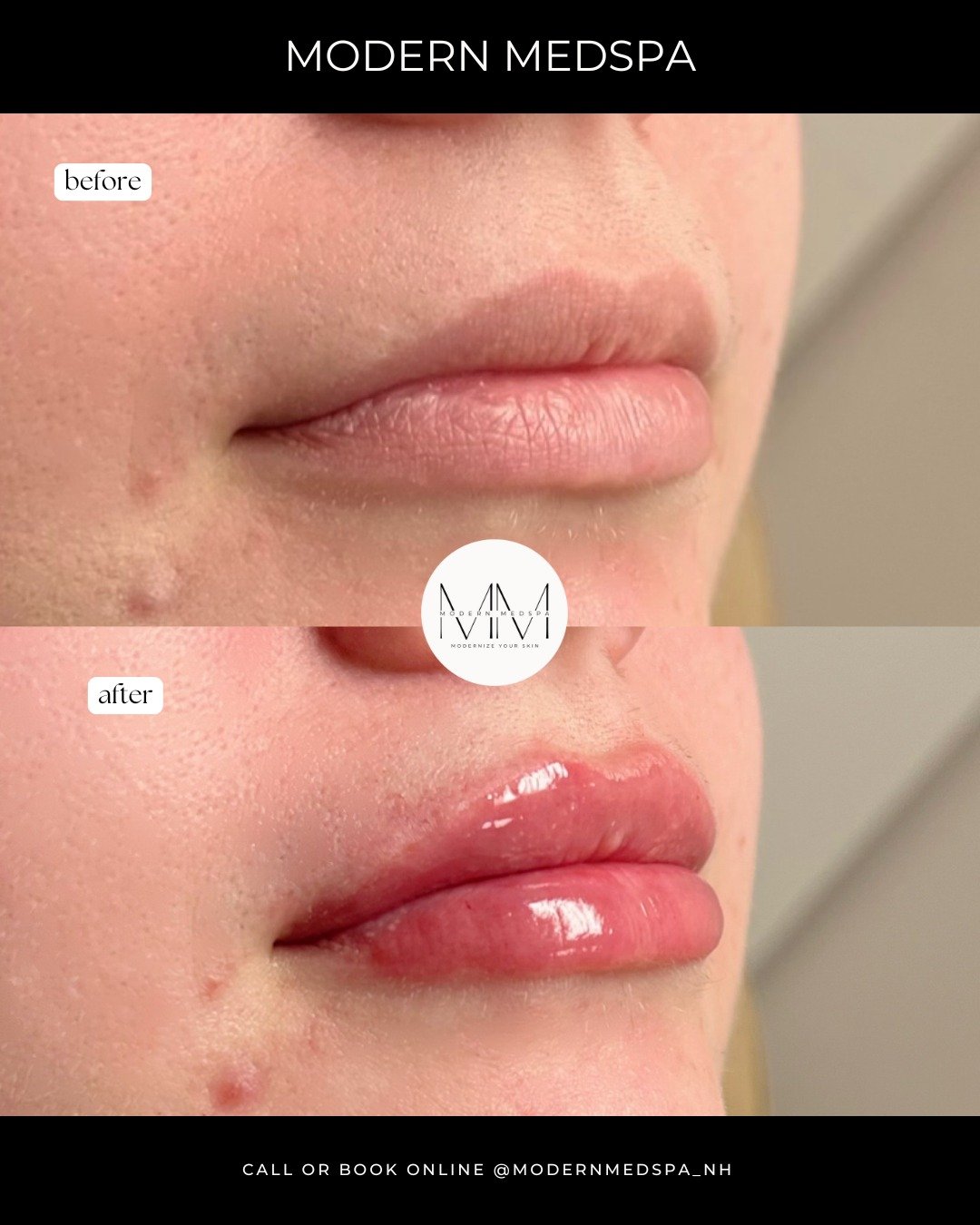 This stunning transformation was achieved with just one syringe of lip filler&mdash;for enhanced shape, hydration, and that perfect plump✨