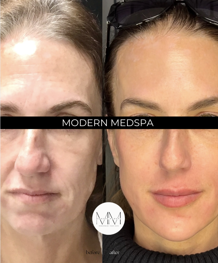 Natural Anti-Aging Treatments in Your 40s: Where to Start at Modern Medspa in Hooksett, NH