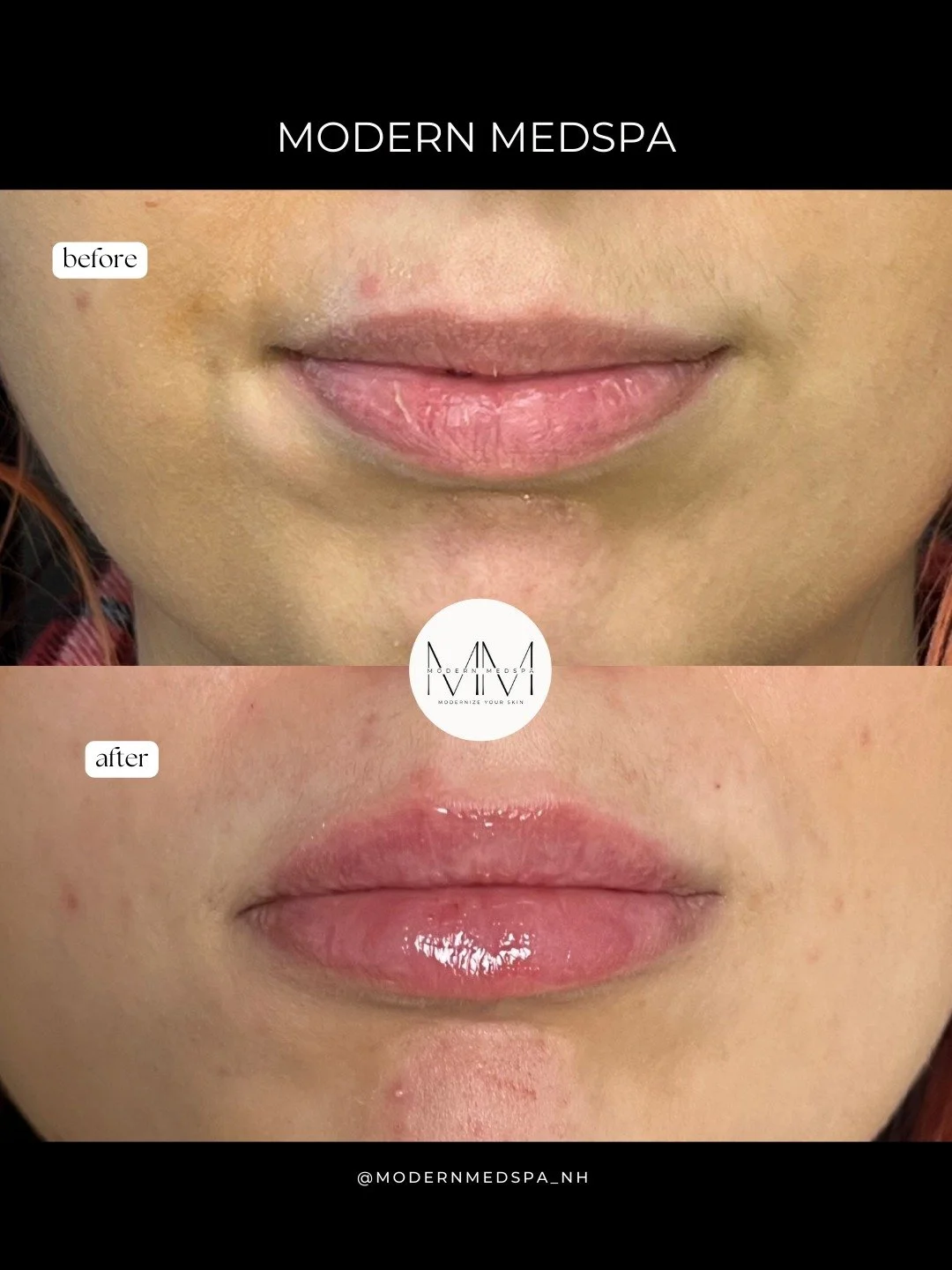 This patient came in wanting subtle volume and a smoother lip shape. Using filler, we restored hydration, added fullness, and created a refreshed, natural look 😍