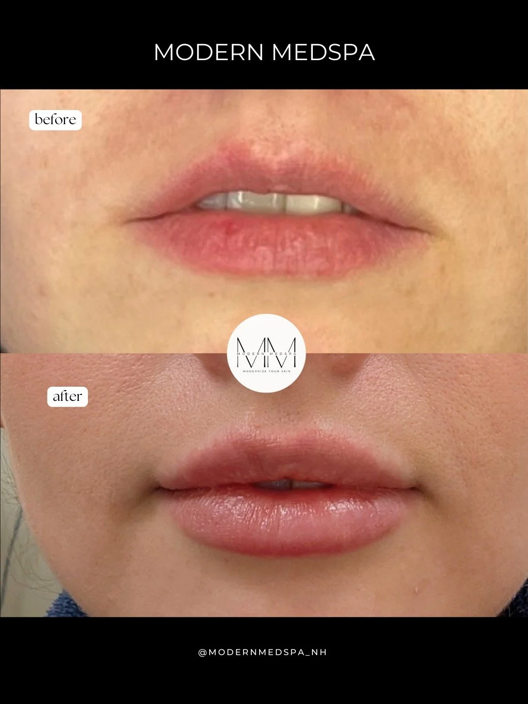 A little definition + volume go a long way. These results show how filler can enhance lip shape while keeping the look soft and natural🫶