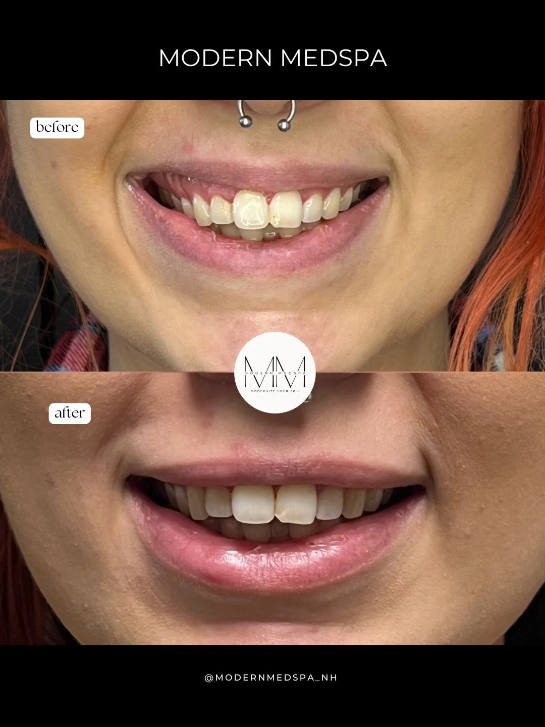 This patient wanted to soften the appearance of her smile. With a few units of Botox, we were able to relax the upper lip muscles, creating a smile that she feels confident in ✨