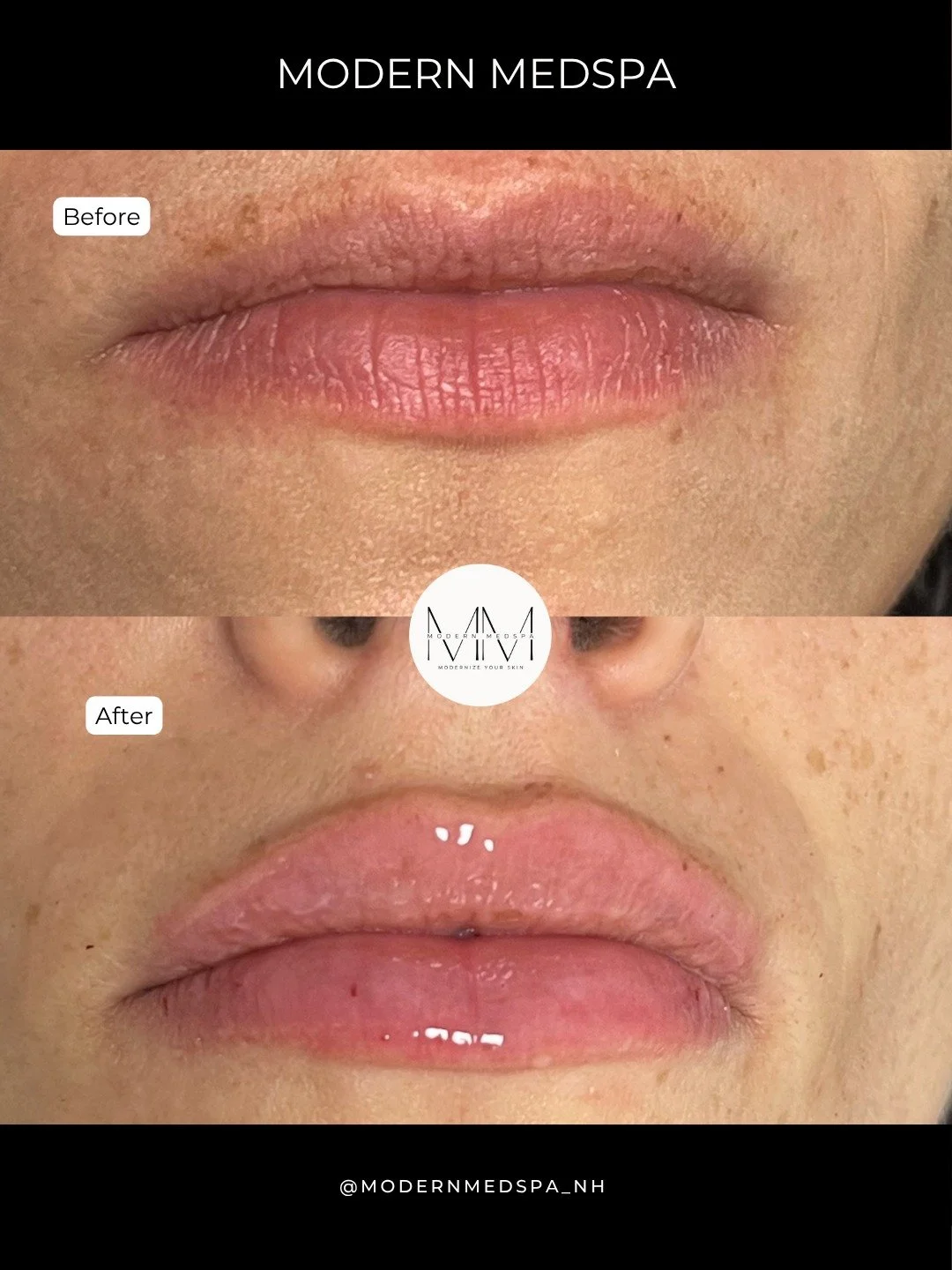 This patient wanted to add volume and definition to her lips while keeping the result soft and natural. With filler, we enhanced the shape and restored hydration for a fuller, refreshed look 💋