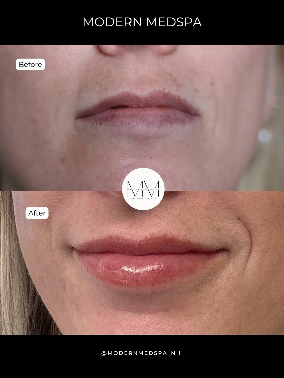 Proof that a little volume goes a long way 💉💋 At Modern Medspa, we focus on customized results that enhance your natural features.