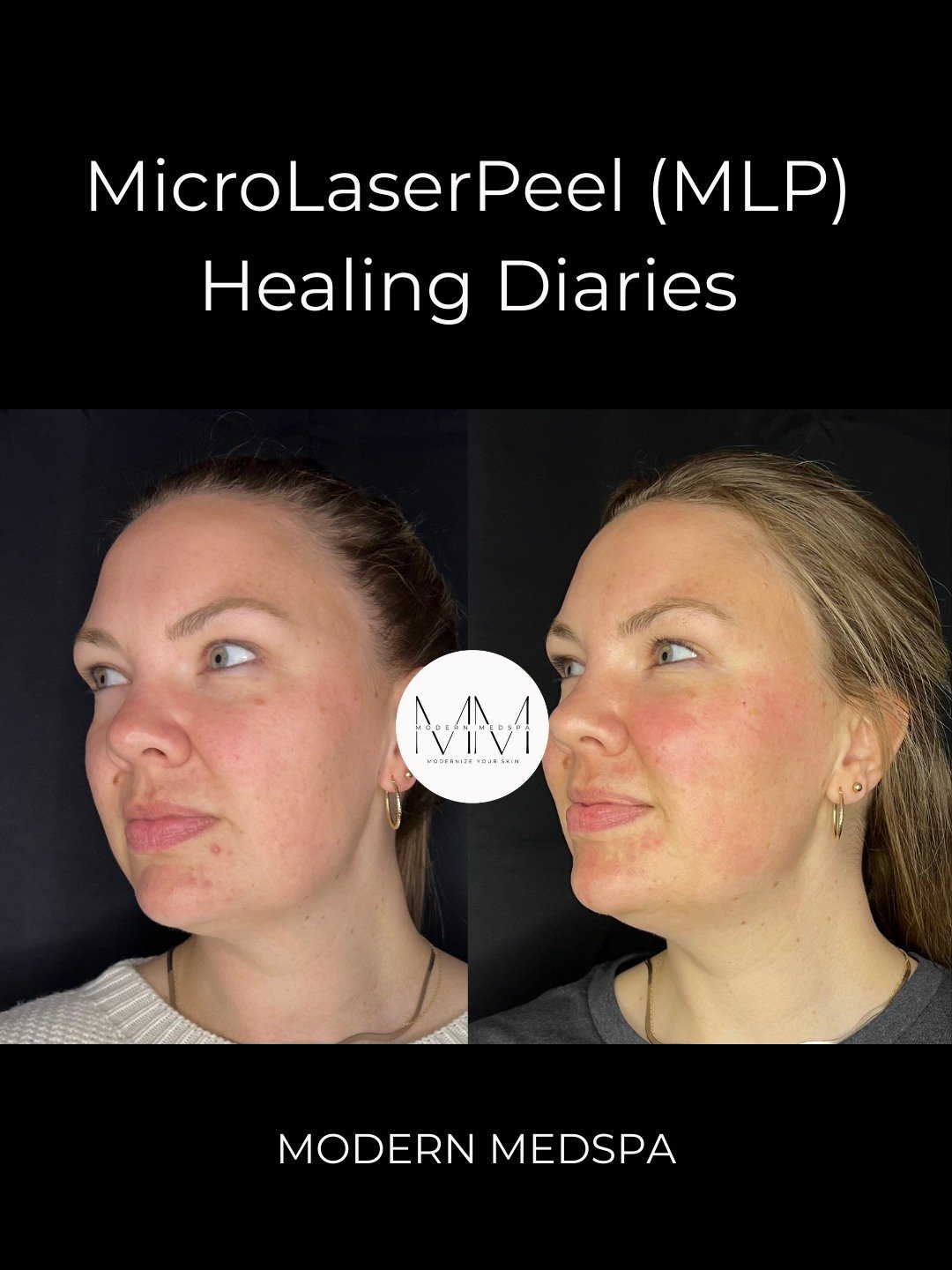 Follow along on my MicroLaserPeel (MLP) journey✨ I did this treatment as a preventative step to keep my skin healthy long-term. A MicroLaserPeel removes the very top layer of damaged skin to smooth texture, even tone, and support fresh cell turnover.