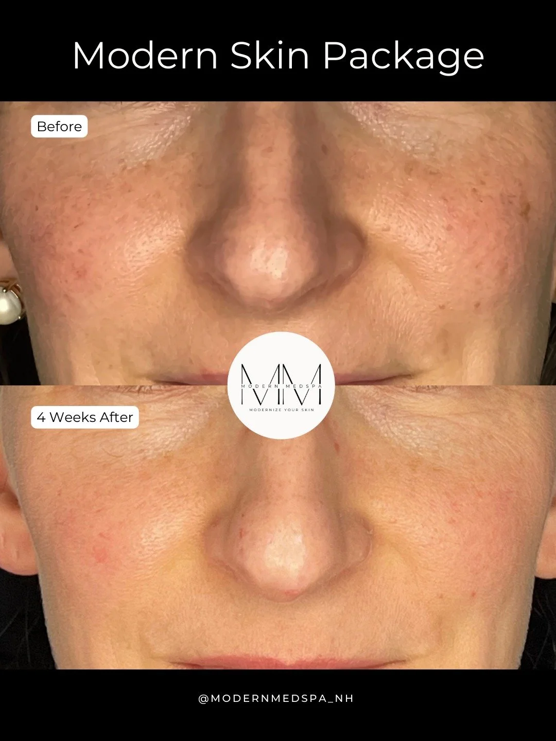 Not sure where to start on your skincare journey? Try our Modern Skin Package, designed to deliver glowing, healthy skin✨

This package includes:
5 full-size ZO Skin Health products customized for your skin type
1 BBL + MOXI treatment to target sun d