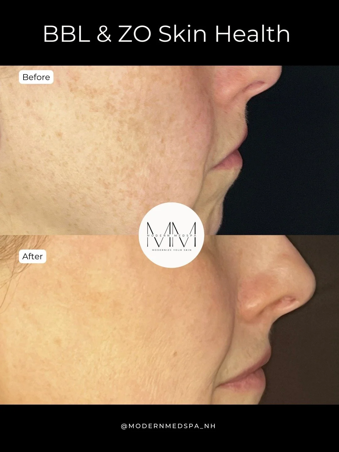BBL combined with ZO Skin Health helps reduce pigmentation and even out skin tone, revealing a brighter, more radiant complexion ✨