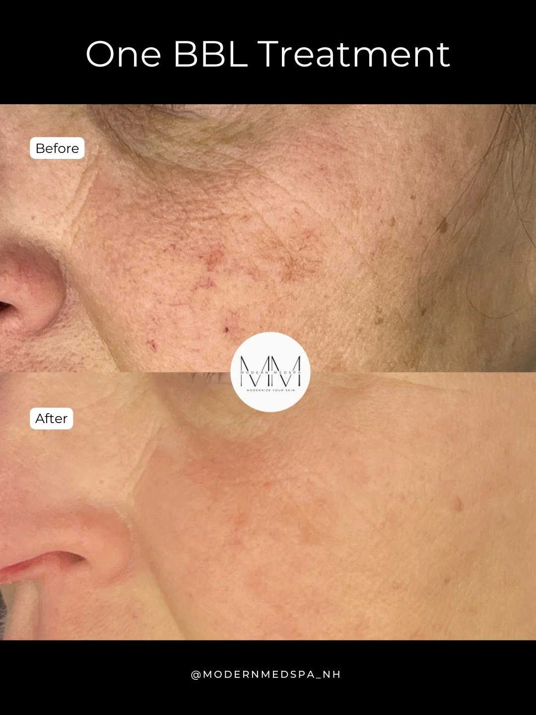 This BBL treatment helped reduce pigmentation, even skin tone, and soften fine lines, leaving a brighter, smoother complexion ✨