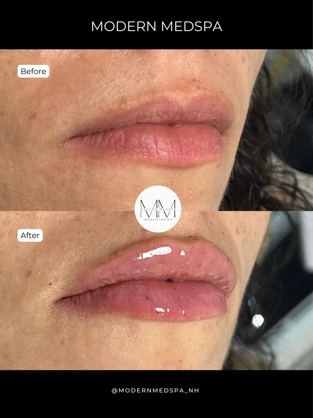 A subtle lip enhancement focused on hydration, balance, and natural results! 💉