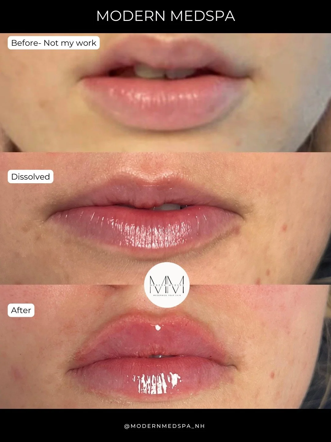 This patient came to us with previous lip filler (not our work). Rather than adding more product, we decided to dissolve and rebuild to improve volume and symmetry ✨
